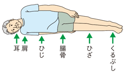 褥瘡の発生部位-側臥位